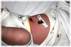 Tocón cordón umbilical