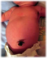 cordon umbilical