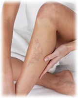 varices