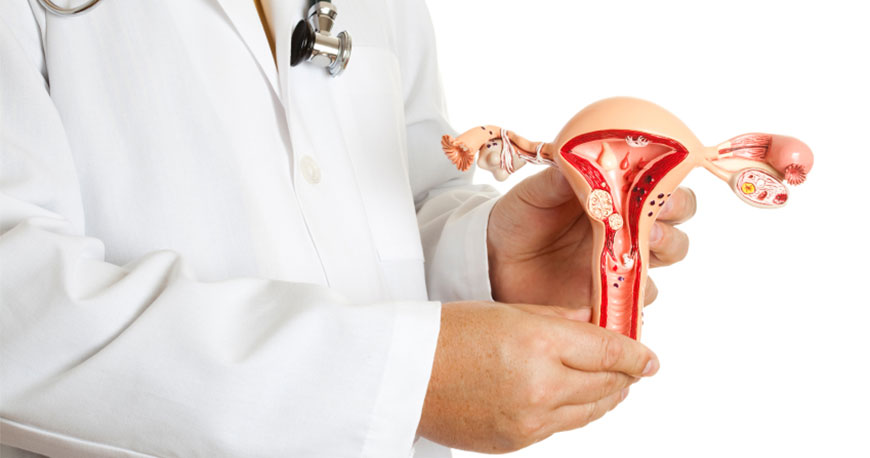 pólipos uterinos