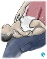 Maniobra de Heimlich