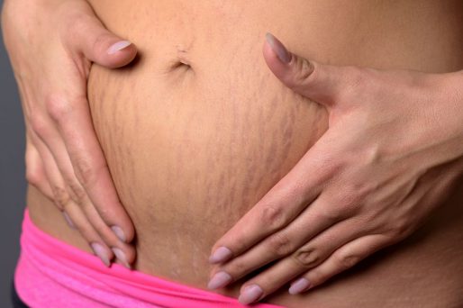prevenir las estrías en el embarazo