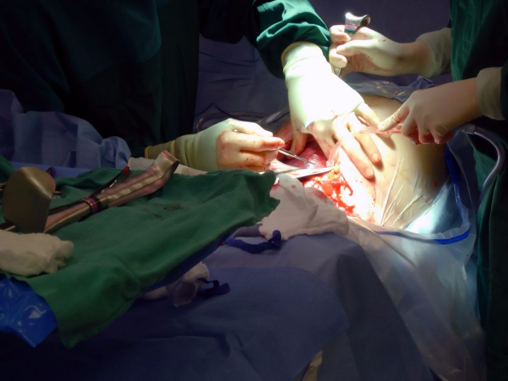 cuidar la herida de una cesárea