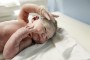 Bebé acostado desnudo- Angioma cavernoso