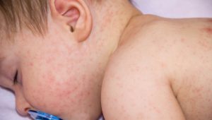 Dermatitis atópica en el bebé