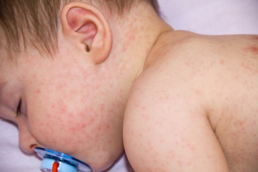 Dermatitis atópica en el bebé