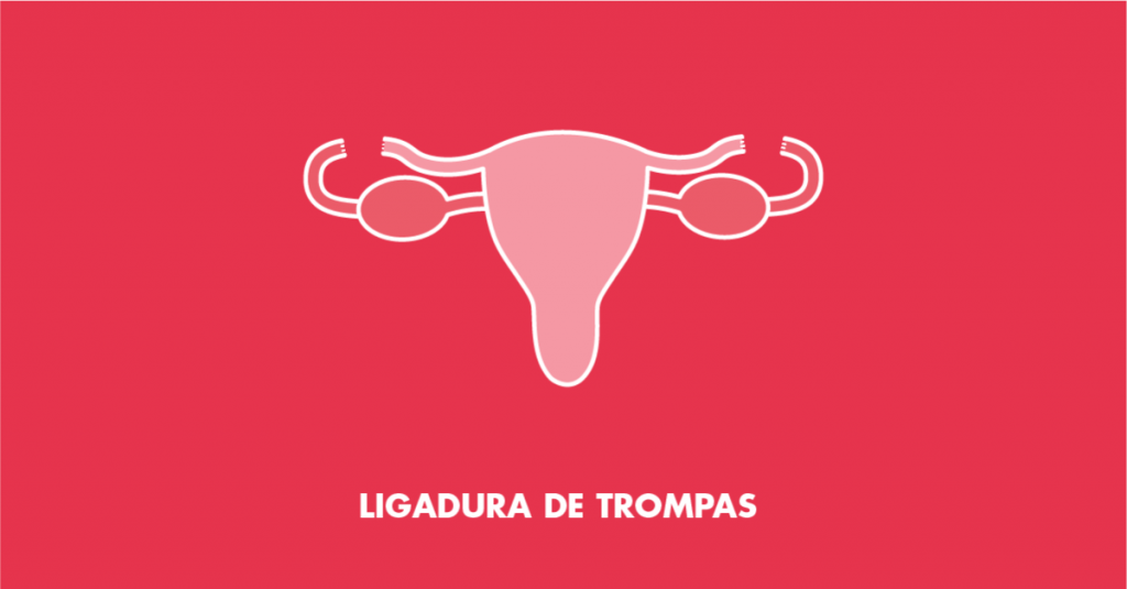 ligarse las trompas