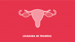 ligarse las trompas