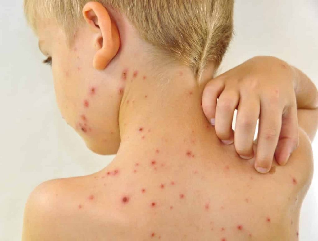 contagio por escabiosis