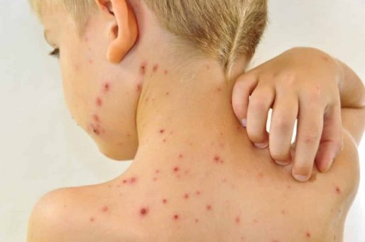contagio por escabiosis