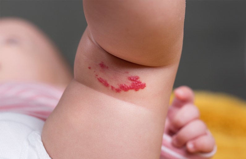 hemangiomas en bebés
