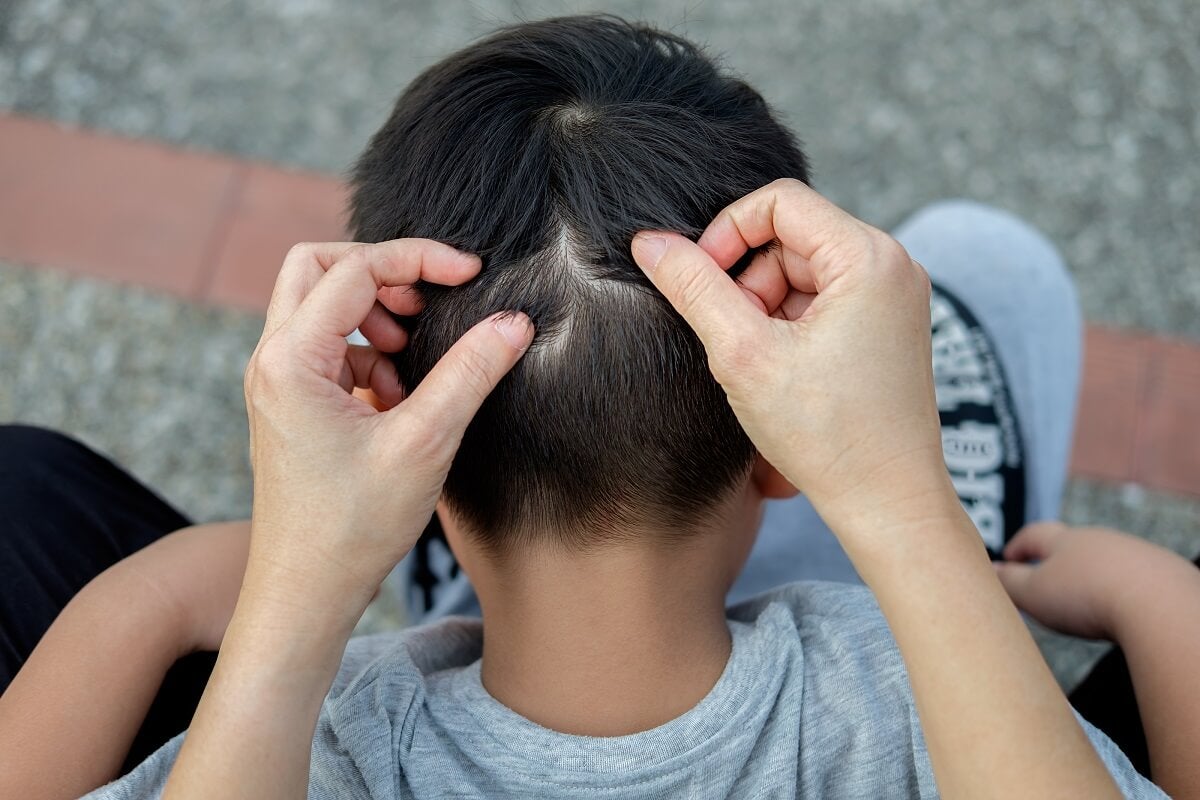 Qué hay detrás de la caída circular del cabello en los niños