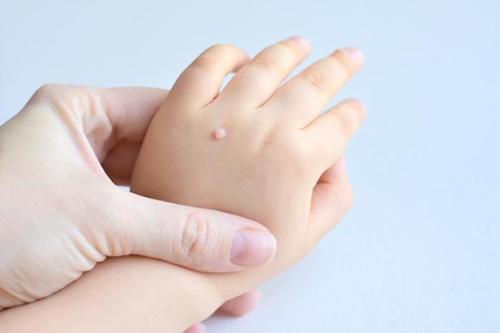 Verrugas en niños