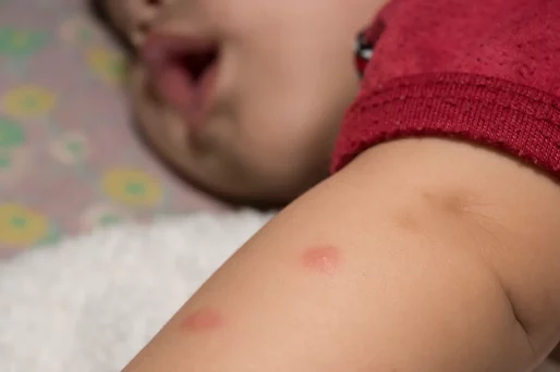 Los daños potenciales de una picadura de garrapata infectada en los niños