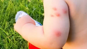 Remedios caseros efectivos para aliviar las picaduras de mosquitos en bebés
