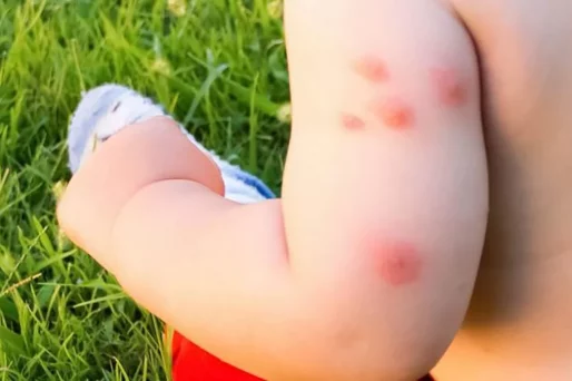 Remedios caseros efectivos para aliviar las picaduras de mosquitos en bebés